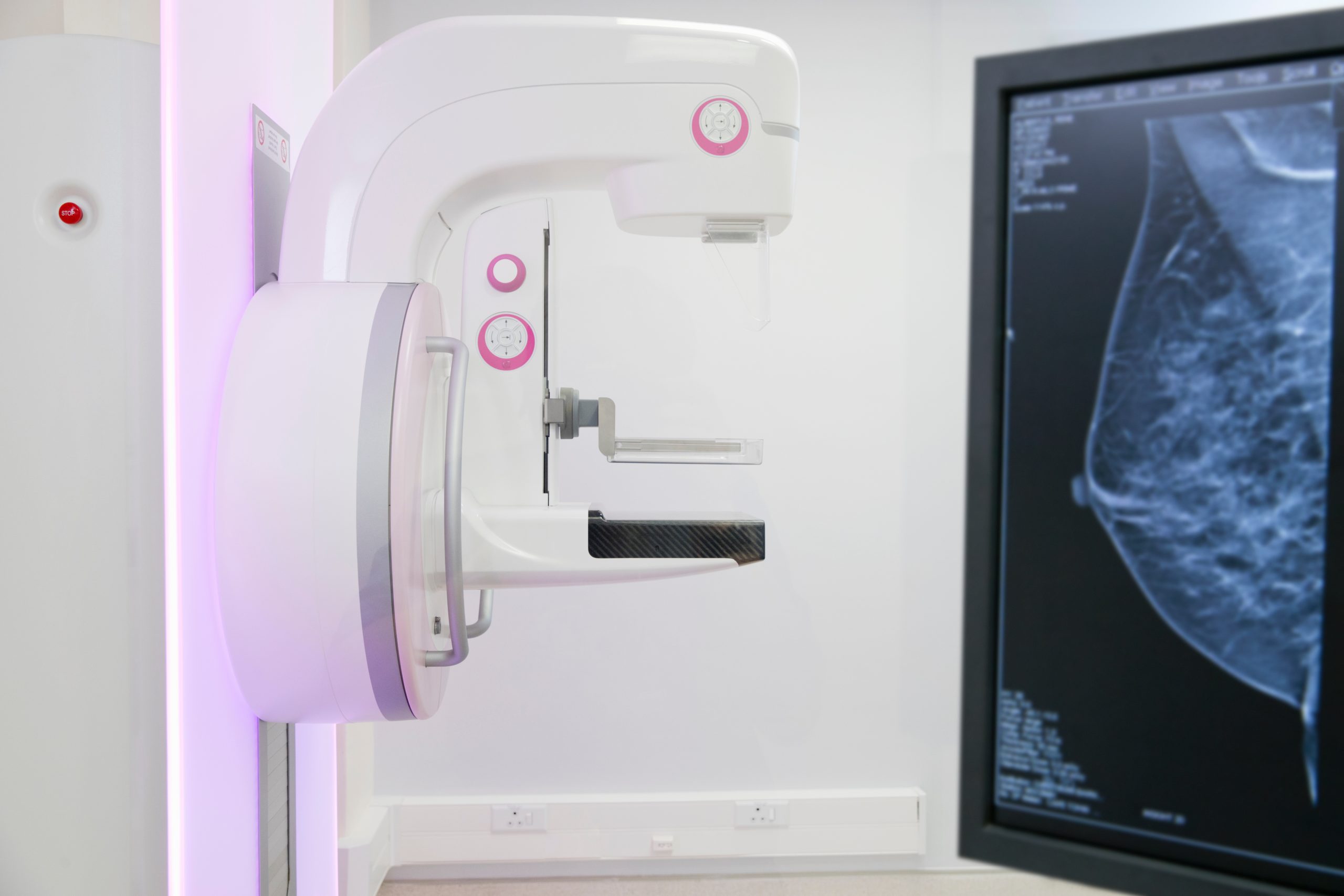 Itapemirim: serviço de mamografia é ampliada para atender municípios da orla Sul